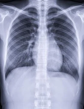 Chest x-ray image for screening diagnosis TB,tuberculosis and covid-19. Illustrazione stock
