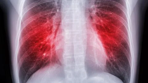 Chest x-ray image for screening diagnosis TB,tuberculosis and covid-19. Stock Illustration