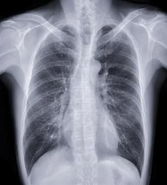 Chest x-ray image for screening diagnosis TB,tuberculosis and covid-19. Stock Illustration