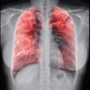 Chest X-ray with Lung 3D rendering image Stock-Illustration