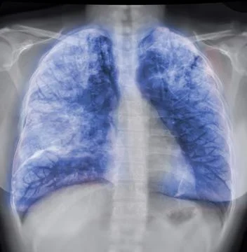 Chest X-ray with Lung 3D rendering image Stock Illustration