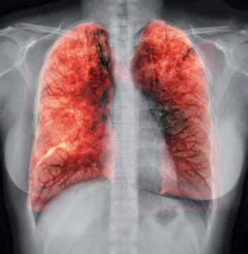 Chest X-ray with Lung 3D rendering image Stock Illustration