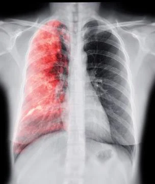 Chest X-ray with Lung 3D rendering image Illustrazione stock