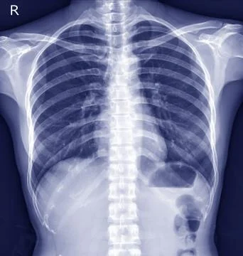 Chest x-ray normal. Stock Photos