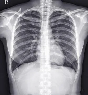 Chest x-ray normal. Stock Photos