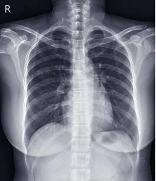 Chest x-ray normal. Stock Photos
