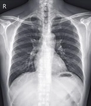 Chest x-ray normal. Stock Photos