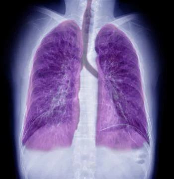 Chest X-ray or X-Ray Image Of Human Chest with 3D rendering of lung for diagn Stock Illustration