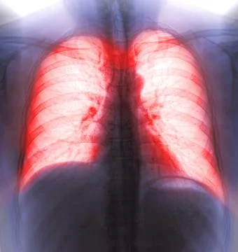 Chest X-ray or X-Ray Image Of Human Chest or Lung ( red zone ) showing tuberc Stock Illustration