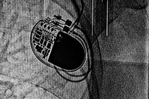 Chest X-ray with a pacemaker Stock Photos