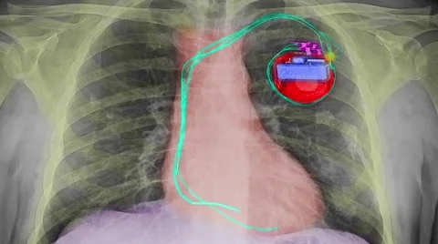 Chest x-ray with pacemaker with simulat... | Stock Video | Pond5
