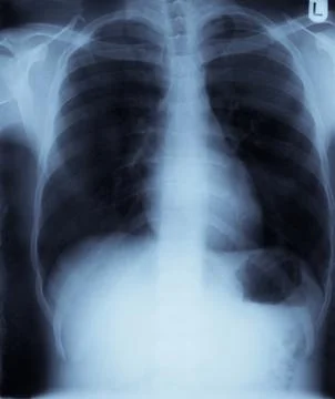 Chest x-ray Foto stock