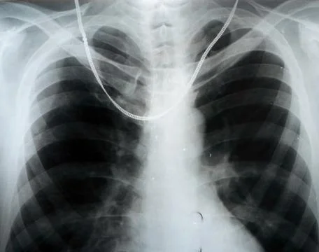 Chest x-ray Stock Photos