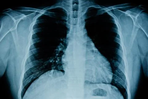Chest x-ray Stock Photos
