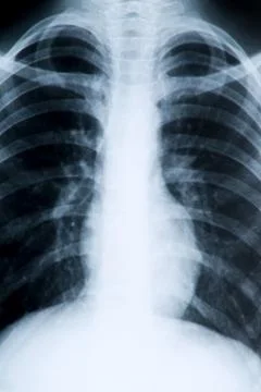 Chest X-ray Stock Photos