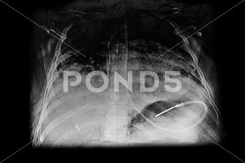 Chest X- ray showing nasogastric tube dobhoff for feeding. ~ Hi Res ...