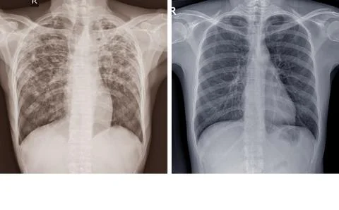 Chest x-ray Showing Normal chest and Pulmonary Tuberculosis ( TB ) Stock Photos