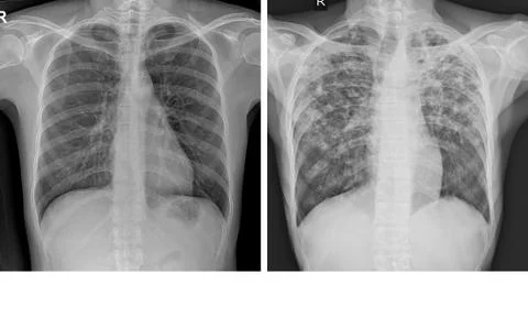 Chest x-ray Showing Normal chest and Pulmonary Tuberculosis ( TB ) Stock Photos