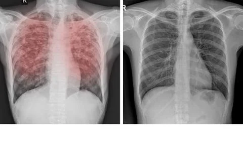 Chest x-ray Showing Normal chest and Pulmonary Tuberculosis ( TB ) Stock Photos