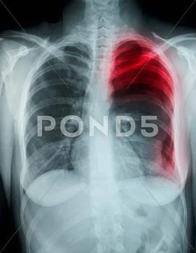 Chest X-Ray, Spontaneous Pneumothorax