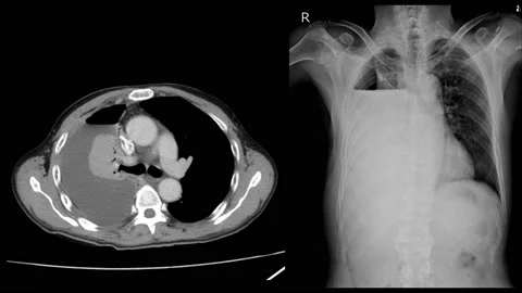 Chest x-ray Two views Severe right pleural effusion with hydropneumothorax. C Stock Footage 158902165