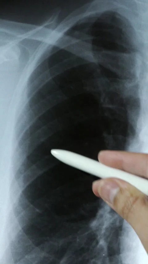 Chest with x-ray.Hand of a doctor analyzi Stock-Footage 337033264