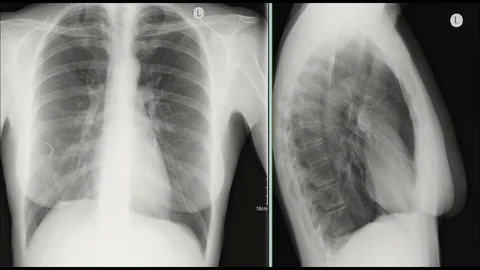 Chest X-rays in direct and side projections Stock Footage