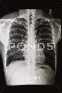 Chest x-rays image Stock Photos