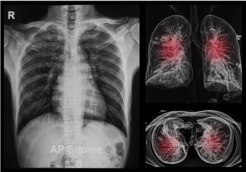 Chest x-rays under 3d image ,lungs 3d image Foto stock