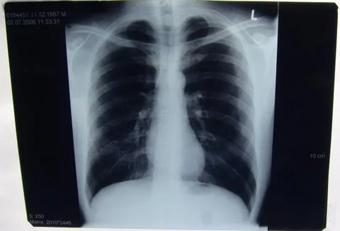 Chest Xray 01 스톡 사진