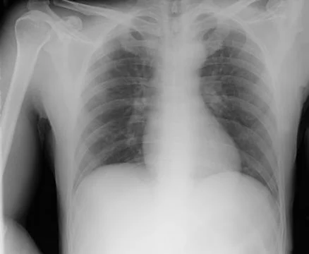 Chest xray Foto stock