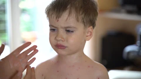 Chicken pox Stock Footage 237932013