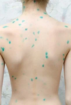 Chicken pox Stock Photos