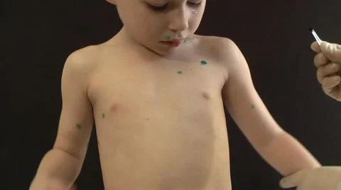Chicken Pox,Alternative Therapy, Stock Footage 10864644