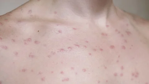 Chickenpox Blisters Close Up Stock Footage 293168573