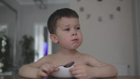 Chickenpox child suffering from itching pimples skin while eating food kitchen Stock Footage 241186147
