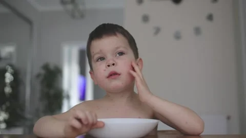 Chickenpox child suffering from itching pimples skin while eating food kitchen Stock Footage 241186253
