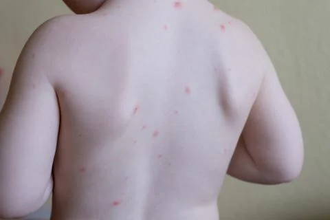 Chickenpox disease Stock Photos