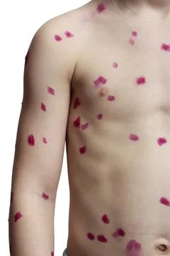 Chickenpox Stock Photos