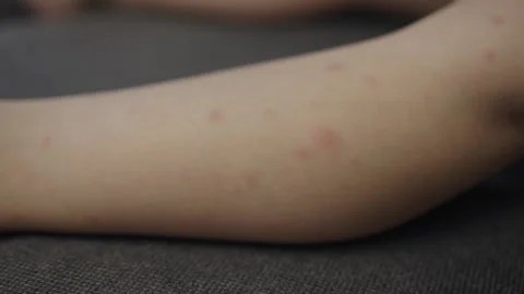 Chickenpox rash blisters filled liquid on child skin kid's leg and body Video stock 242371603