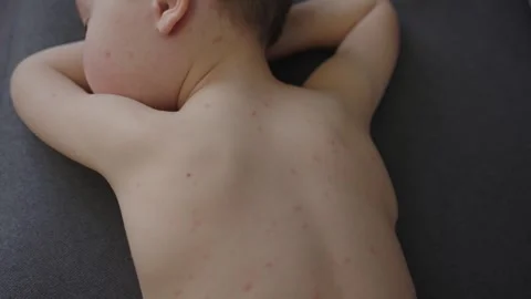 Chickenpox rash blisters filled liquid on child skin back stomach leg and body 库存影片 242371656