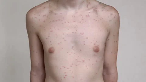 Chickenpox Rash on Body Stock Footage 293173510
