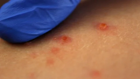 Chickenpox Rash Examination by Doctor in... | Stock Video | Pond5