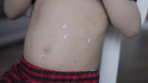 Child affected with chickenpox red spots all over body cotton swab medicine is Stock Footage 275751107