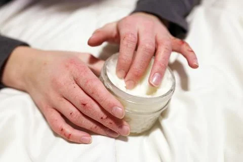 Child Applying Moisturizing Lotion to Extremely Cracked and Dry Skin on his H Stock Photos
