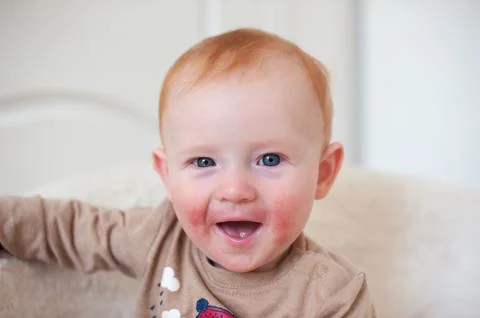 Child with atopic dermatitis Stock Photos