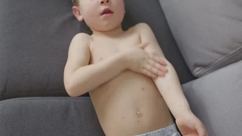 Child battling with chickenpox lying on sofa body with red spots illness boy is Stock Footage 283407719