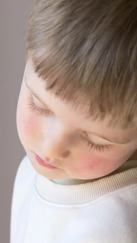 Child boy face with redness and rash symptoms, allergy and dermatitis concept in Stock Footage 330973172