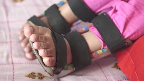 Child cerebral palsy disability, legs orthosis. Stock Footage