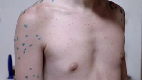 Child with Chickenpox Stock Footage 293175885
